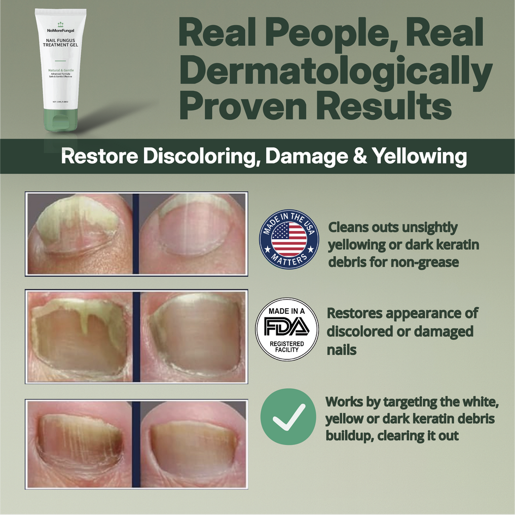 Treat Nails & Kill 99% Of Bacteria With 2x Faster Acting Formula Using NoMore™
